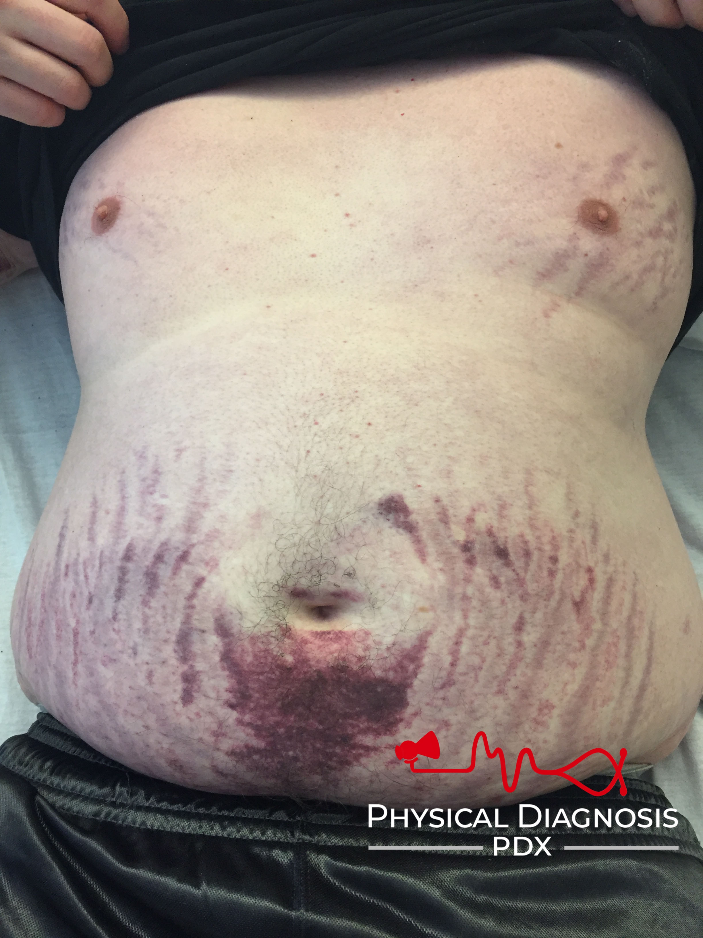 Cushings syndrome: Abdominal striae
