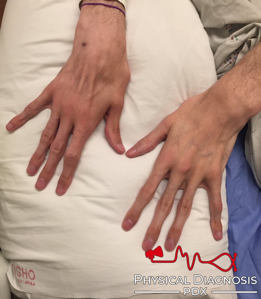 Conditions: Marfans syndrome